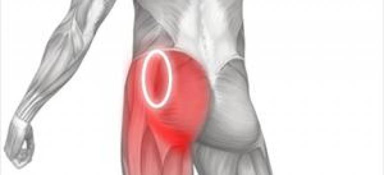 spot gluteus medius referral