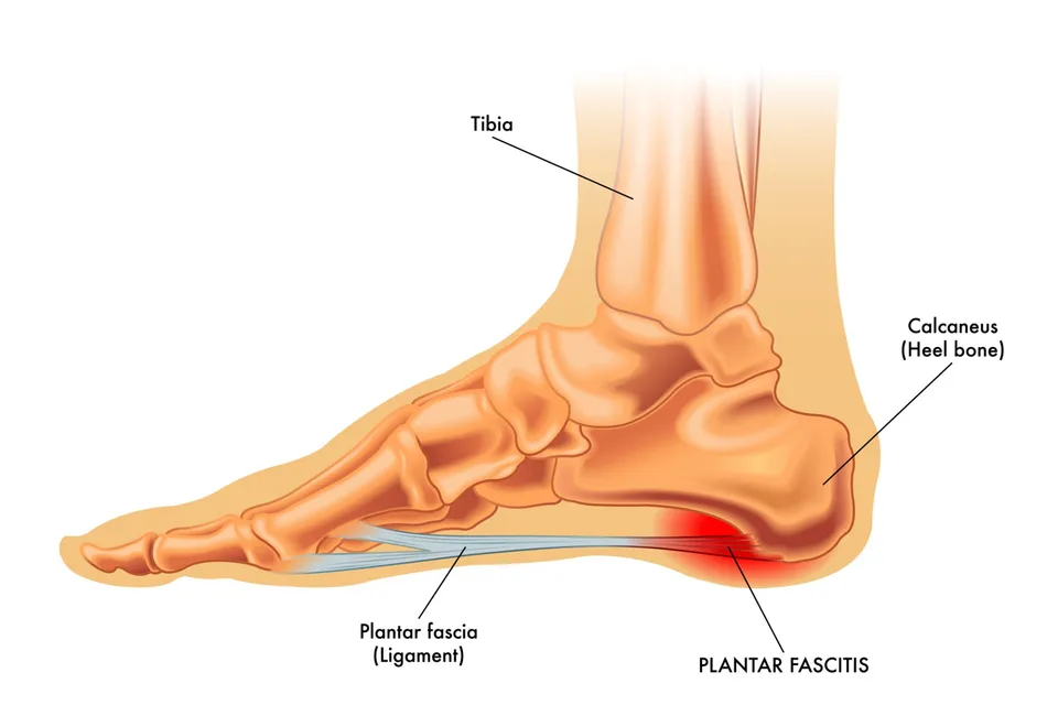 Signs of plantar fascia shop