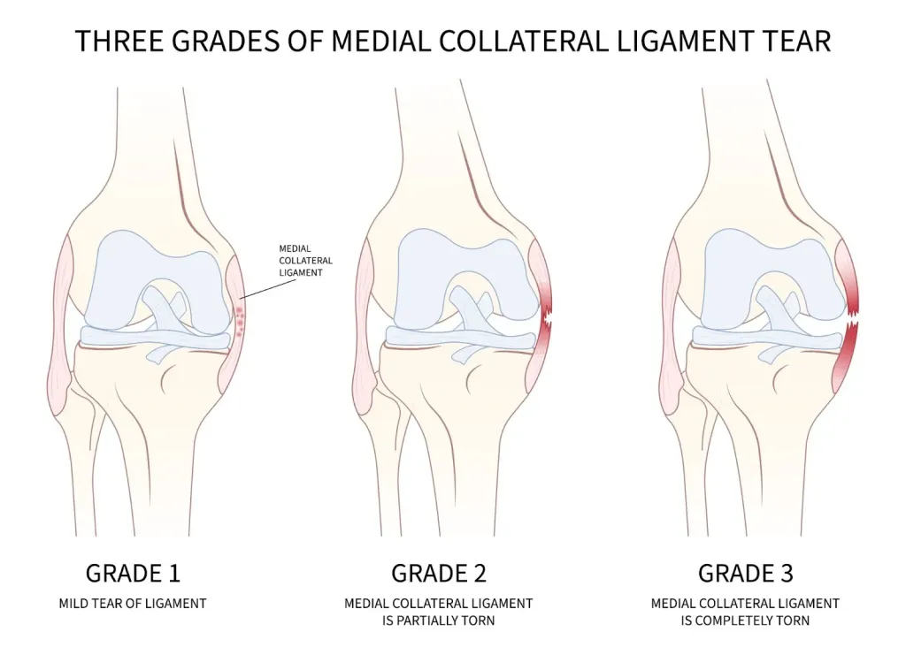 MCL Injuries - Osteopathy Gold Coast
