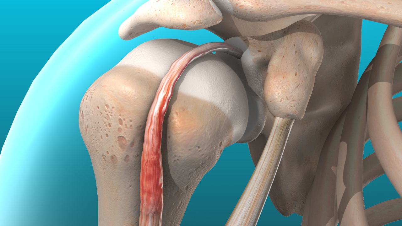 What Is Tendonitis? What Is Tendonitis?